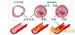 吸煙對(duì)血管的危害大嗎 五大吸煙對(duì)血管壁的危害